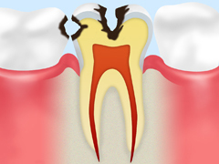 C2【象牙質に達したむし歯】
