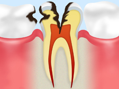 C3【神経に達したむし歯】
