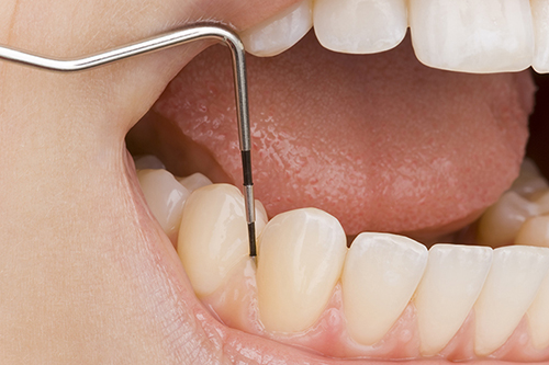歯ぐきの腫れや出血は「歯周病」のサインです